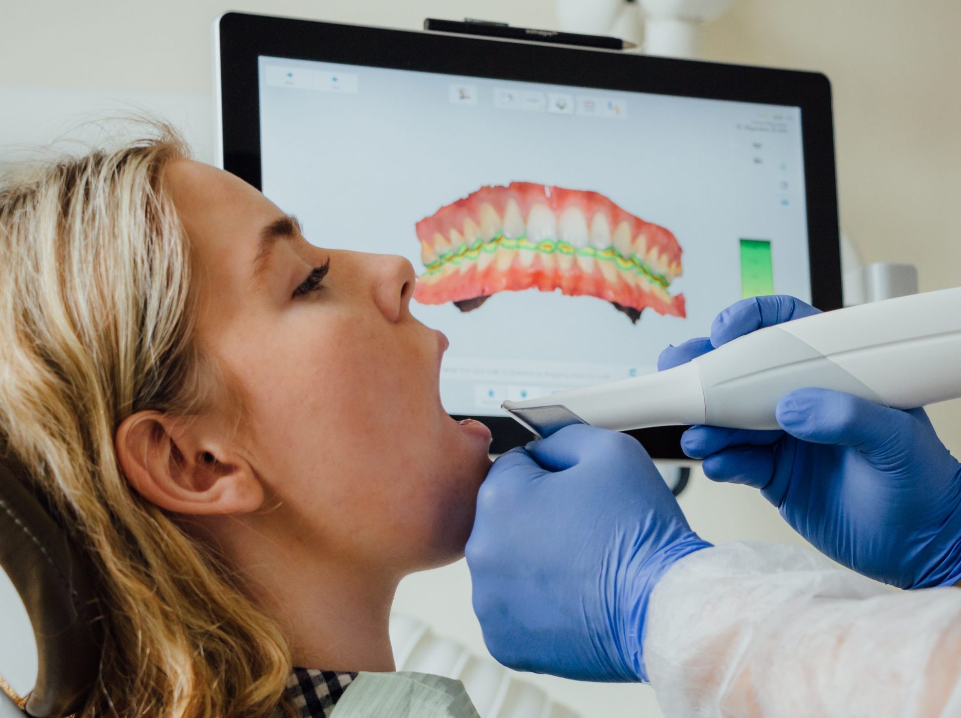 dantų protezavimas skaitmeninis dantų skenavimas 3shape