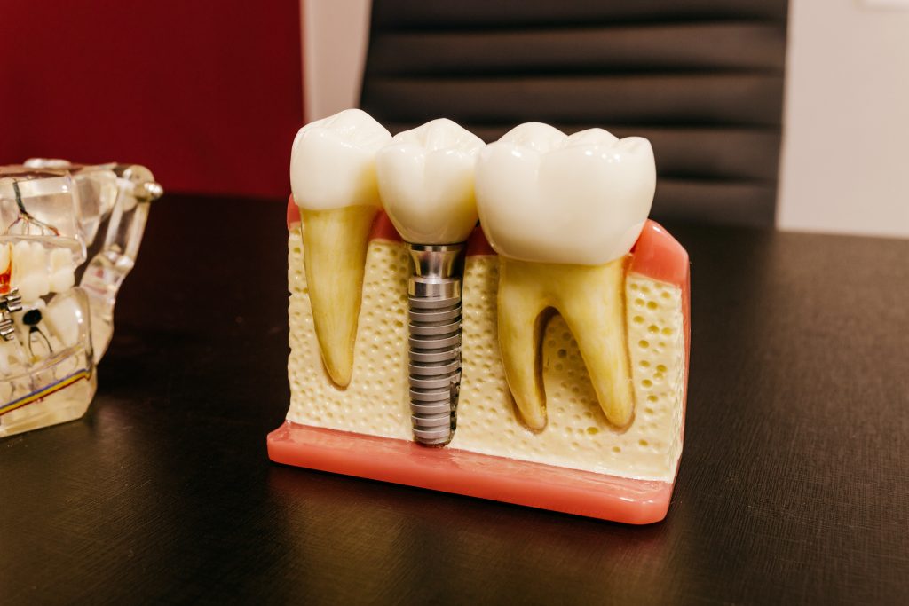 dantų implantai kaina
