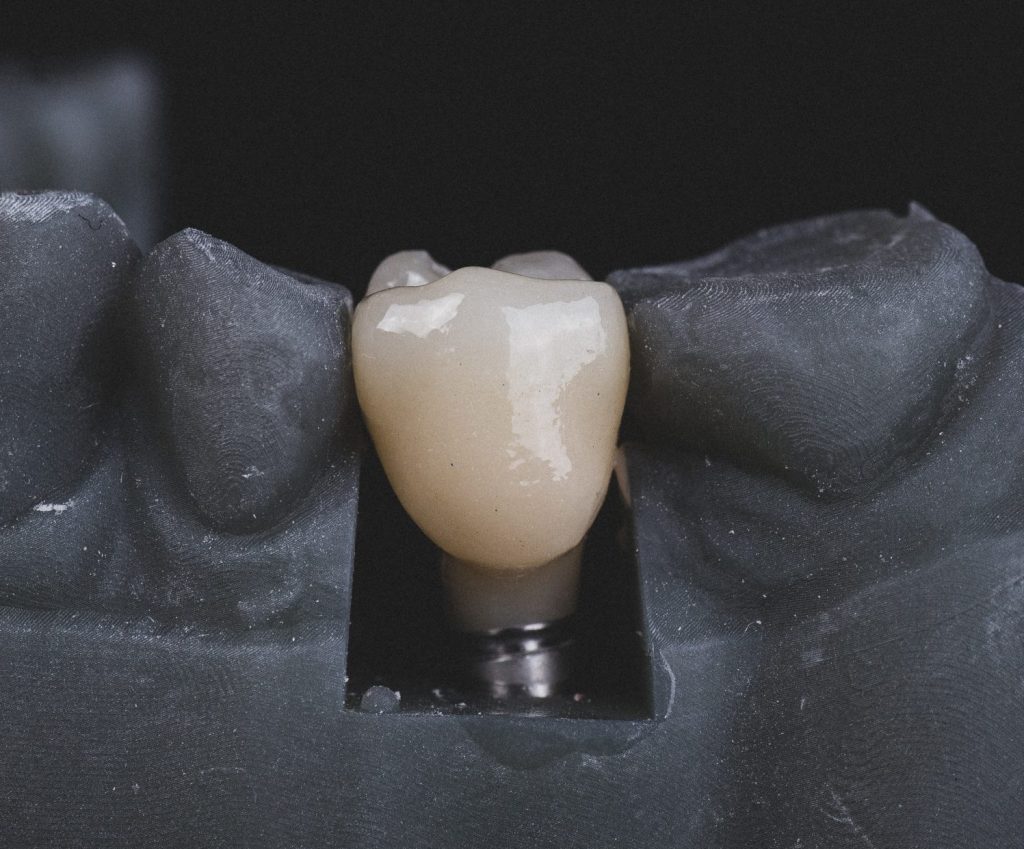 dantų protezavimas ant implantų