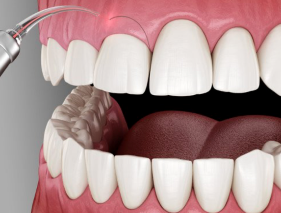 periodontologija gydymas lazeriu dantenos pasaitėlio plastika kaina vilnius