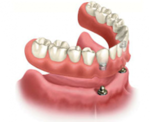 Išimami dantų protezai ant implantų
