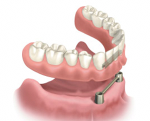 Išimami dantų protezai ant implantų