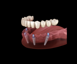 all on 4 dantų implantacijos metodas