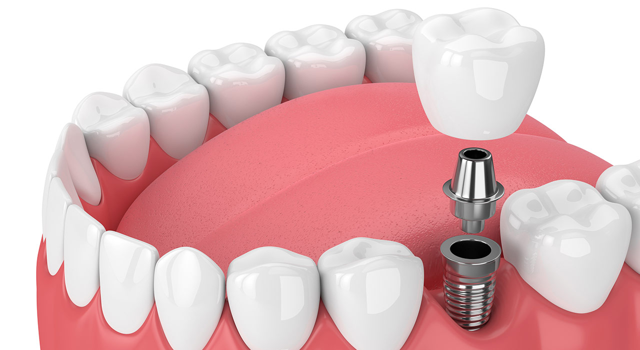dantų implantacija vilniuje kaina