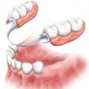 dantų lanko atraminiai protezai