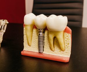 dantų implantai kaina
